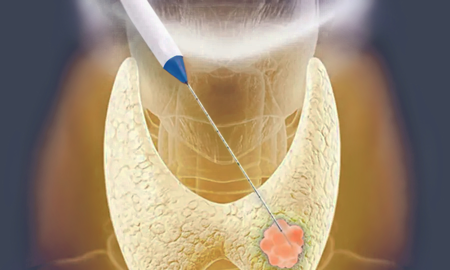 Thyroid-RFA-Procedure-Saint-Johns-Cancer-Institute.jpg Thyroid-RFA-Procedure-Saint-Johns-Cancer-Institute.jpg