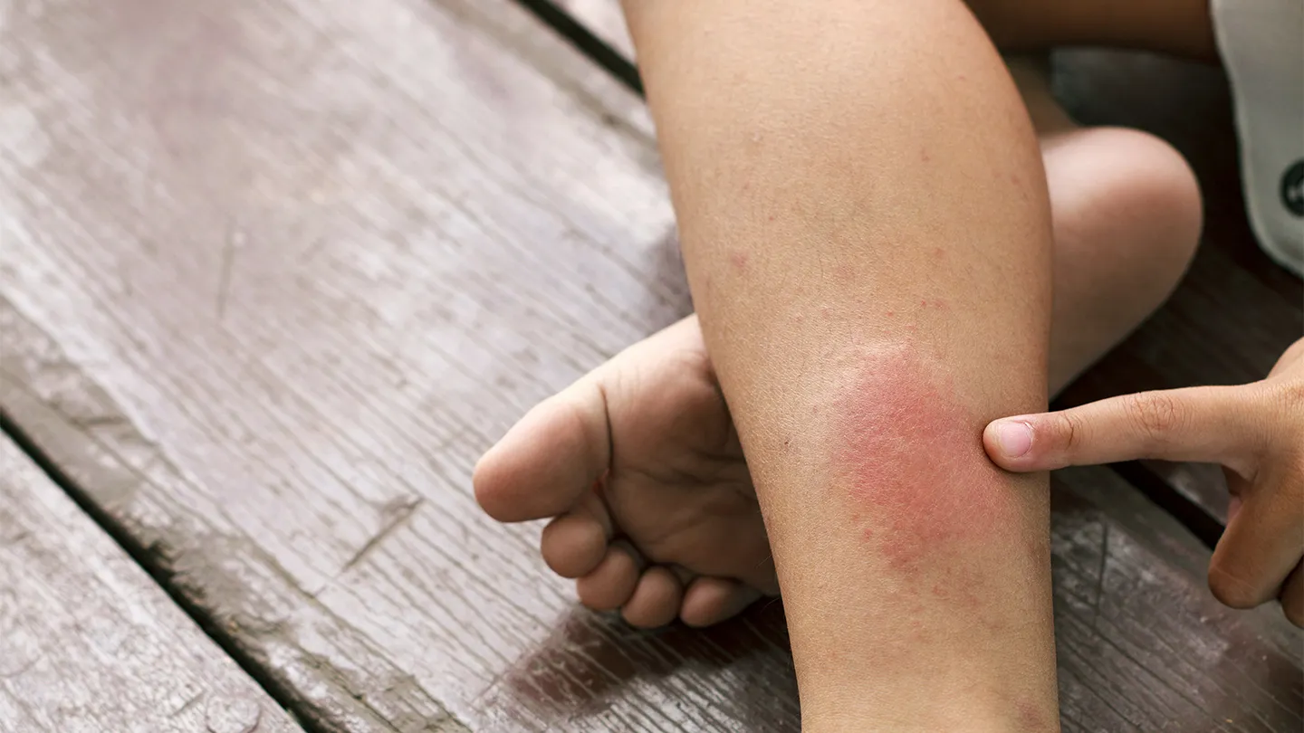 5 signs blood clot forming body Jaju IR Clinic Aurangabad